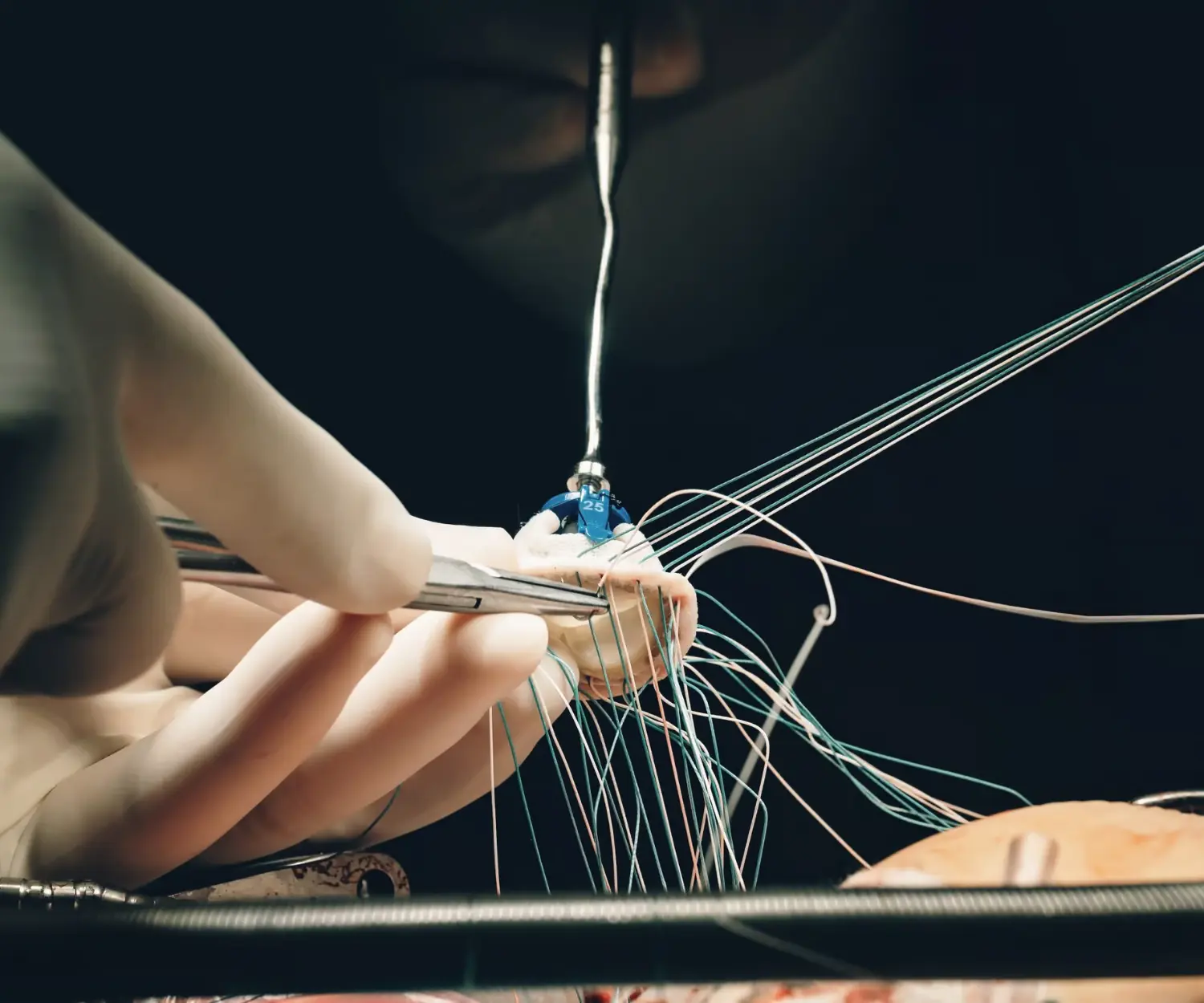 Kapalı Yöntem<br />Kapak Ameliyatları